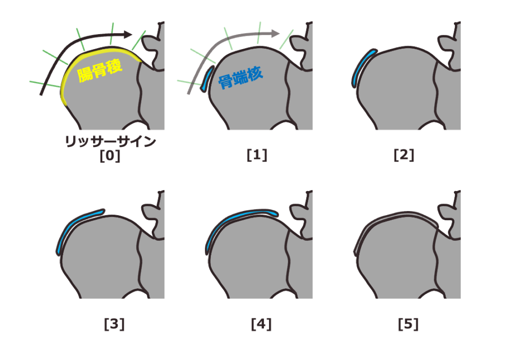 リッサーサインを説明した図