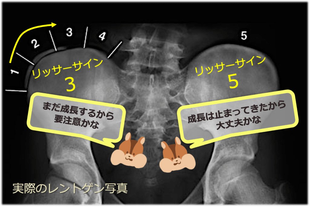 リッサーサインのレントゲン写真