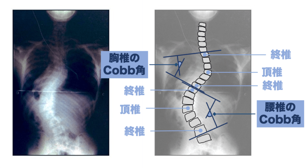 側弯症のレントゲン写真とコブ角